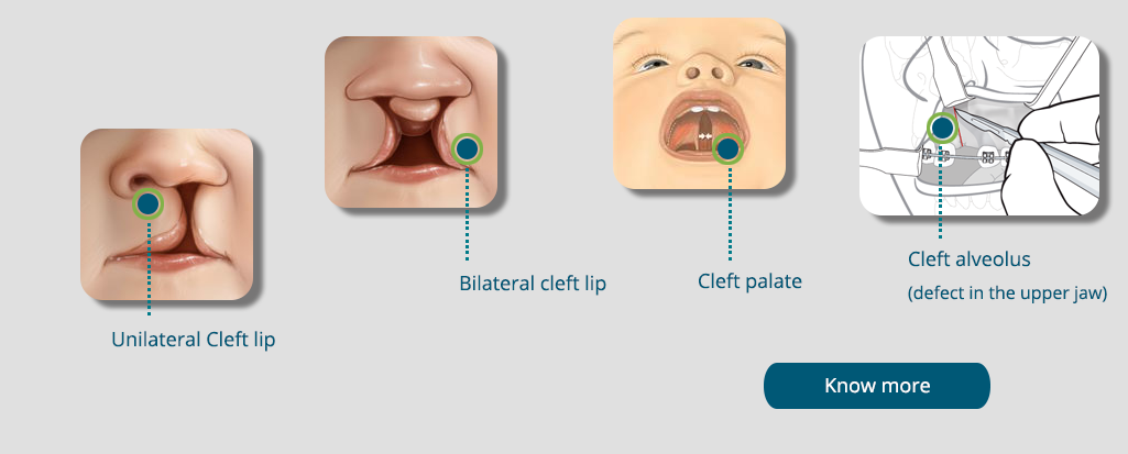 cleft lip & palate surgery