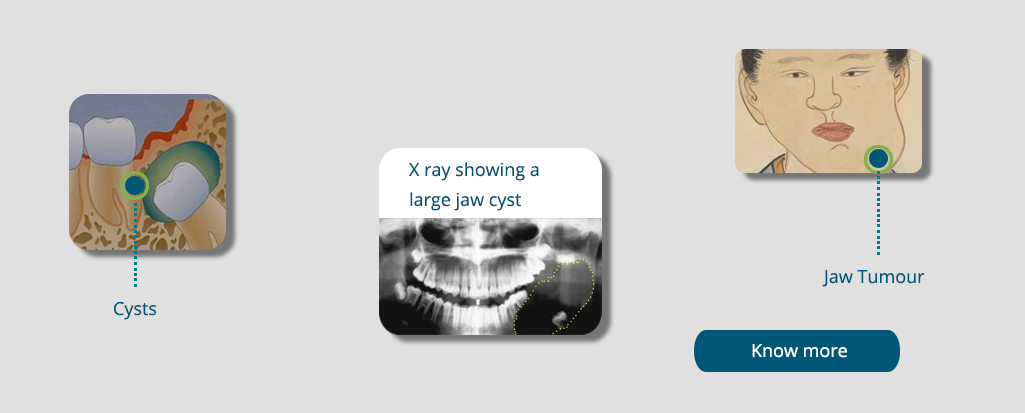 Jaw cysts and tumours