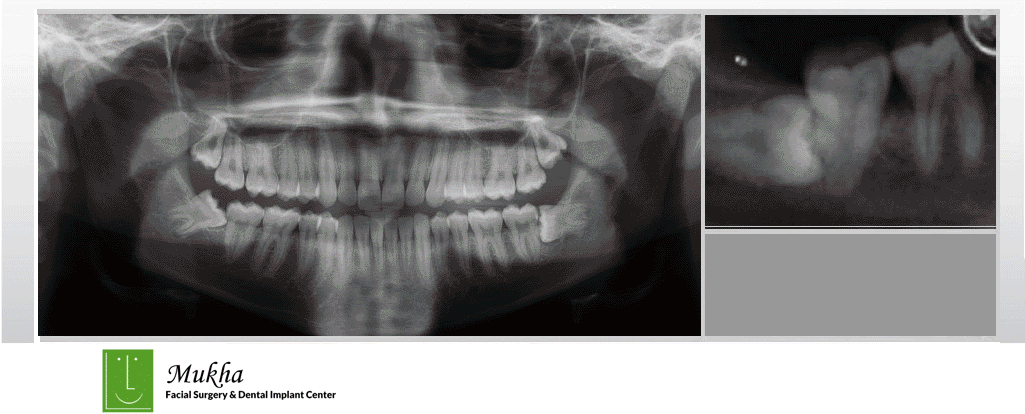 x-ray showing impacted wisdom teeth